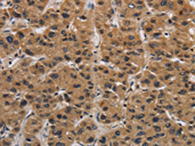 The image on the left is immunohistochemistry of paraffin-embedded Human liver cancer tissue using ITGB7 Antibody(ITGB7 Antibody) at dilution 1/30, on the right is treated with synthetic peptide. (Original magnification: ×200)