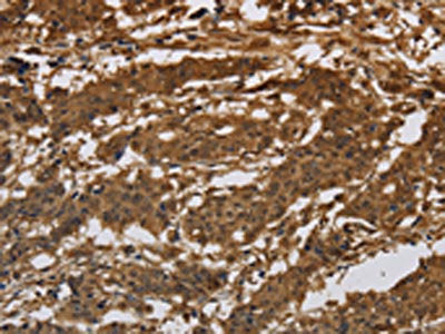 The image on the left is immunohistochemistry of paraffin-embedded Human gastic cancer tissue using the antibody Antibody) at dilution 1/30, on the right is treated with synthetic peptide. (Original magnification: ×200)