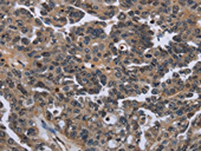 The image on the left is immunohistochemistry of paraffin-embedded Human ovarian cancer tissue using ITGAE Antibody(ITGAE Antibody) at dilution 1/50, on the right is treated with fusion protein. (Original magnification: ×200)