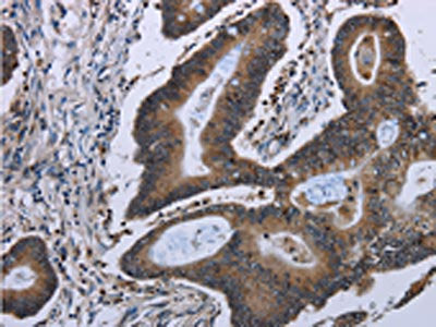 The image on the left is immunohistochemistry of paraffin-embedded Human colon cancer tissue using the antibody Antibody) at dilution 1/50, on the right is treated with fusion protein. (Original magnification: ×200)