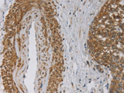 The image on the left is immunohistochemistry of paraffin-embedded Human cervical cancer tissue using the antibody Antibody) at dilution 1/30, on the right is treated with fusion protein. (Original magnification: ×200)Rabbit anti-Human EMC8 Polyclonal Antibody