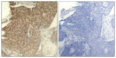 Immunohistochemical analysis of paraffin-embedded human breast carcinoma tissue using HDAC2(Phospho-Ser394) Antibody(left) or the same antibody preincubated with blocking peptide(right).Rabbit anti-Human HDAC2 Polyclonal Antibody