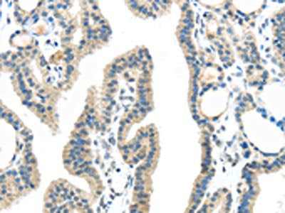 The image on the left is immunohistochemistry of paraffin-embedded Human thyroid cancer tissue using VPS4A Antibody(VPS4A Antibody) at dilution 1/25, on the right is treated with synthetic peptide. (Original magnification: ×200)Rabbit anti-Human VPS4A Polyclonal Antibody