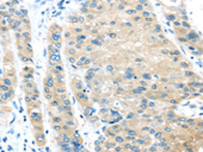 The image on the left is immunohistochemistry of paraffin-embedded Human liver cancer tissue using the antibody Antibody) at dilution 1/25, on the right is treated with synthetic peptide. (Original magnification: ×200)Rabbit anti-Human VPS4A Polyclonal Antibody