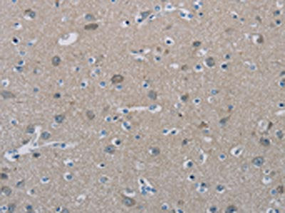 The image on the left is immunohistochemistry of paraffin-embedded Human brain  tissue using PHKG2 Antibody(PHKG2 Antibody) at dilution 1/20, on the right is treated with synthetic peptide. (Original magnification: ×200)Rabbit anti-Human PHKG2 Polyclonal Antibody