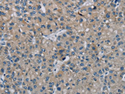 The image on the left is immunohistochemistry of paraffin-embedded Human liver cancer tissue using the antibody Antibody) at dilution 1/20, on the right is treated with synthetic peptide. (Original magnification: ×200)Rabbit anti-Human PHKG2 Polyclonal Antibody