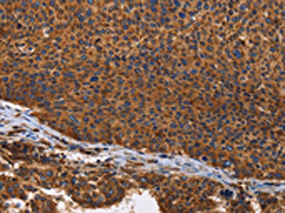 The image on the left is immunohistochemistry of paraffin-embedded Human liver cancer tissue using the antibody Antibody) at dilution 1/60, on the right is treated with fusion protein. (Original magnification: ×200)Rabbit anti-Human ILK Polyclonal Antibody