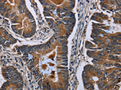 The image on the left is immunohistochemistry of paraffin-embedded Human colon cancer tissue using SLC1A6 Antibody(SLC1A6 Antibody) at dilution 1/40, on the right is treated with synthetic peptide. (Original magnification: ×200)Rabbit anti-Human SLC1A6 Polyclonal Antibody