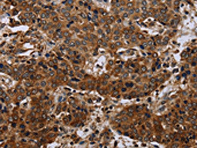 The image on the left is immunohistochemistry of paraffin-embedded Human liver cancer tissue using the antibody Antibody) at dilution 1/40, on the right is treated with synthetic peptide. (Original magnification: ×200)Rabbit anti-Human SLC1A6 Polyclonal Antibody