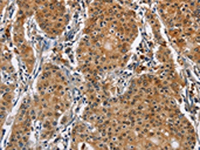 The image on the left is immunohistochemistry of paraffin-embedded Human gastric cancer tissue using CAT Antibody(CAT Antibody) at dilution 1/40, on the right is treated with fusion protein. (Original magnification: ×200)