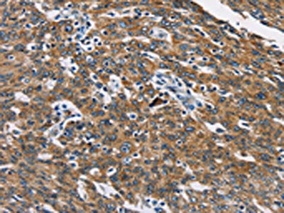 The image on the left is immunohistochemistry of paraffin-embedded Human ovarian cancer tissue using the antibody Antibody) at dilution 1/40, on the right is treated with fusion protein. (Original magnification: ×200)