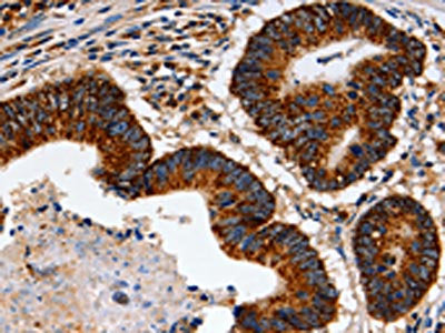 The image on the left is immunohistochemistry of paraffin-embedded Human colon cancer tissue using the antibody Antibody) at dilution 1/60, on the right is treated with fusion protein. (Original magnification: ×200)Rabbit anti-Human TRAP1 Polyclonal Antibody