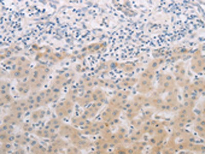 The image on the left is immunohistochemistry of paraffin-embedded Human liver cancer tissue using PGA3/PGA4/PGA5 Antibody(PGA3/PGA4/PGA5 Antibody) at dilution 1/60, on the right is treated with synthetic peptide. (Original magnification: ×200)Rabbit anti-Human PGA3/PGA4/PGA5 Polyclonal Antibody