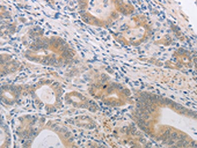 The image on the left is immunohistochemistry of paraffin-embedded Human gastric cancer tissue using the antibody Antibody) at dilution 1/60, on the right is treated with synthetic peptide. (Original magnification: ×200)Rabbit anti-Human PGA3/PGA4/PGA5 Polyclonal Antibody