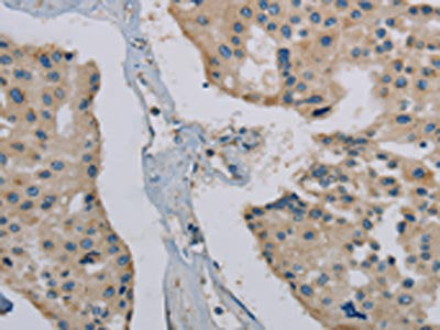 The image on the left is immunohistochemistry of paraffin-embedded Human prostate cancer tissue using PHKG1 Antibody(PHKG1 Antibody) at dilution 1/20, on the right is treated with synthetic peptide. (Original magnification: ×200)Rabbit anti-Human PHKG1 Polyclonal Antibody