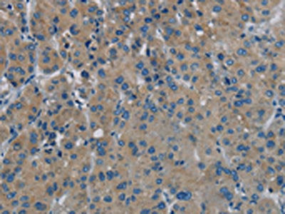 The image on the left is immunohistochemistry of paraffin-embedded Human liver cancer tissue using the antibody Antibody) at dilution 1/20, on the right is treated with synthetic peptide. (Original magnification: ×200)Rabbit anti-Human PHKG1 Polyclonal Antibody