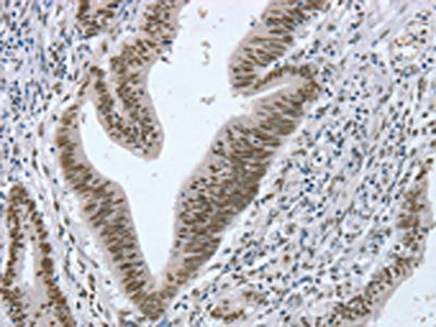 The image on the left is immunohistochemistry of paraffin-embedded Human colon cancer tissue using RNF20 Antibody(RNF20 Antibody) at dilution 1/20, on the right is treated with fusion protein. (Original magnification: ×200)Rabbit anti-Human RNF20 Polyclonal Antibody