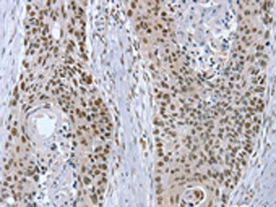 The image on the left is immunohistochemistry of paraffin-embedded Human esophagus cancer tissue using the antibody Antibody) at dilution 1/20, on the right is treated with fusion protein. (Original magnification: ×200)Rabbit anti-Human RNF20 Polyclonal Antibody