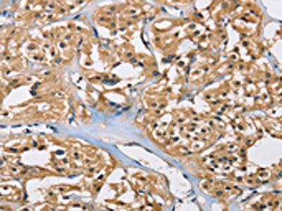 The image on the left is immunohistochemistry of paraffin-embedded Human thyroid cancer tissue using the antibody Antibody) at dilution 1/40, on the right is treated with fusion protein. (Original magnification: ×200)Rabbit anti-Human PPP3CA Polyclonal Antibody