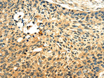 The image on the left is immunohistochemistry of paraffin-embedded Human esophagus cancer tissue using LILRB2 Antibody(LILRB2 Antibody) at dilution 1/20, on the right is treated with fusion protein. (Original magnification: ×200)Rabbit anti-Human LILRB2 Polyclonal Antibody