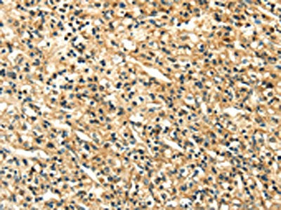 The image on the left is immunohistochemistry of paraffin-embedded Human prostate cancer tissue using the antibody Antibody) at dilution 1/20, on the right is treated with fusion protein. (Original magnification: ×200)Rabbit anti-Human LILRB2 Polyclonal Antibody
