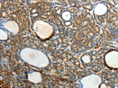 The image on the left is immunohistochemistry of paraffin-embedded Human thyroid cancer tissue using SLC25A11 Antibody(SLC25A11 Antibody) at dilution 1/40, on the right is treated with fusion protein. (Original magnification: ×200)Rabbit anti-Human SLC25A11 Polyclonal Antibody