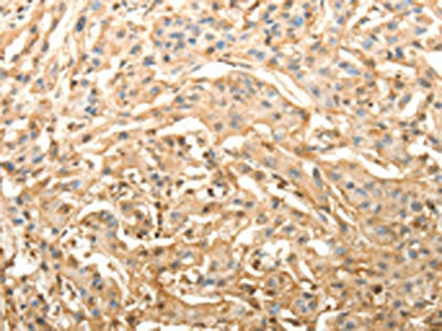 The image on the left is immunohistochemistry of paraffin-embedded Human lung cancer tissue using the antibody Antibody) at dilution 1/40, on the right is treated with fusion protein. (Original magnification: ×200)Rabbit anti-Human SLC25A11 Polyclonal Antibody