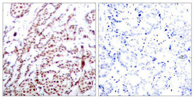 Immunohistochemical analysis of paraffin-embedded human breast carcinoma tissue using ATF2(Phospho-Thr73 or 55) Antibody(left) or the same antibody preincubated with blocking peptide(right).Rabbit anti-Human ATF2 Polyclonal Antibody