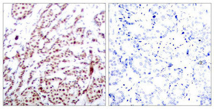 Immunohistochemical analysis of paraffin-embedded human breast carcinoma tissue using ATF2(Phospho-Thr73 or 55) Antibody(left) or the same antibody preincubated with blocking peptide(right).Rabbit anti-Human ATF2 Polyclonal Antibody