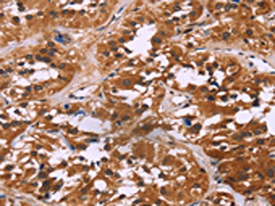 The image on the left is immunohistochemistry of paraffin-embedded Human thyroid cancer tissue using LMNB1 Antibody(LMNB1 Antibody) at dilution 1/60, on the right is treated with fusion protein. (Original magnification: ×200)