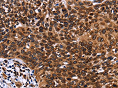 The image on the left is immunohistochemistry of paraffin-embedded Human cervical cancer tissue using the antibody Antibody) at dilution 1/60, on the right is treated with fusion protein. (Original magnification: ×200)