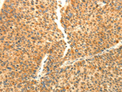 The image on the left is immunohistochemistry of paraffin-embedded Human liver cancer tissue using AARS2 Antibody(AARS2 Antibody) at dilution 1/80, on the right is treated with fusion protein. (Original magnification: ×200)Rabbit anti-Human AARS2 Polyclonal Antibody