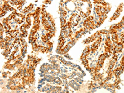 The image on the left is immunohistochemistry of paraffin-embedded Human thyroid cancer tissue using the antibody Antibody) at dilution 1/80, on the right is treated with fusion protein. (Original magnification: ×200)