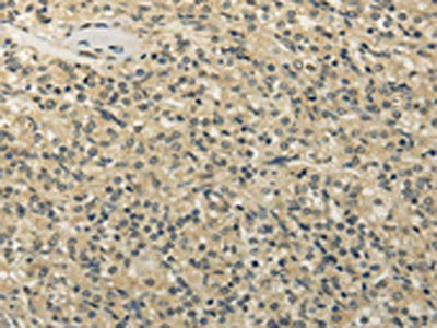 The image on the left is immunohistochemistry of paraffin-embedded Human prostate cancer tissue using TBC1D22A Antibody(TBC1D22A Antibody) at dilution 1/20, on the right is treated with fusion protein. (Original magnification: ×200)Rabbit anti-Human TBC1D22A Polyclonal Antibody