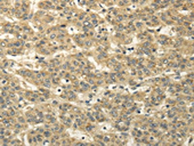 The image on the left is immunohistochemistry of paraffin-embedded Human liver cancer tissue using the antibody Antibody) at dilution 1/20, on the right is treated with fusion protein. (Original magnification: ×200)Rabbit anti-Human TBC1D22A Polyclonal Antibody