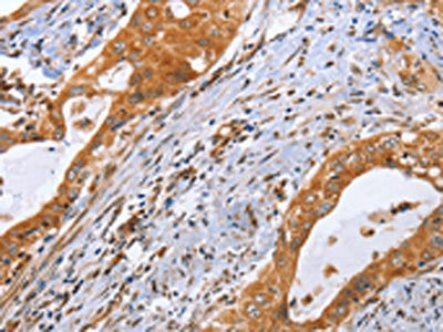 The image on the left is immunohistochemistry of paraffin-embedded Human cervical cancer tissue using CDK19 Antibody(CDK19 Antibody) at dilution 1/70, on the right is treated with synthetic peptide. (Original magnification: X200)Rabbit anti-Human CDK19 Polyclonal Antibody