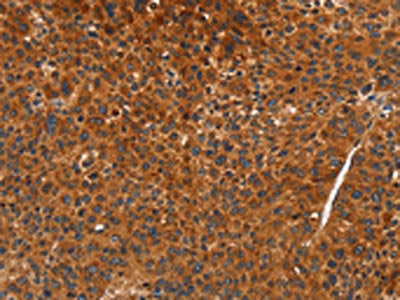 The image on the left is immunohistochemistry of paraffin-embedded Human liver cancer tissue using the antibody Antibody) at dilution 1/70, on the right is treated with synthetic peptide. (Original magnification: X200)Rabbit anti-Human CDK19 Polyclonal Antibody