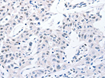 The image on the left is immunohistochemistry of paraffin-embedded Human lung cancer tissue using POMC Antibody(POMC Antibody) at dilution 1/30, on the right is treated with synthetic peptide. (Original magnification: ×200)Rabbit anti-Human POMC Polyclonal Antibody