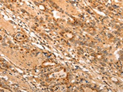 The image on the left is immunohistochemistry of paraffin-embedded Human gastic cancer tissue using ADRA1B Antibody(ADRA1B Antibody) at dilution 1/20, on the right is treated with synthetic peptide. (Original magnification: ×200)Rabbit anti-Human ADRA1B Polyclonal Antibody