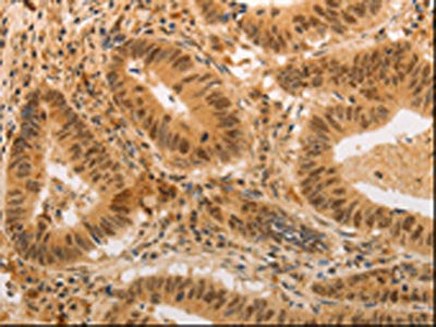 The image on the left is immunohistochemistry of paraffin-embedded Human colon cancer tissue using the antibody Antibody) at dilution 1/20, on the right is treated with synthetic peptide. (Original magnification: ×200)