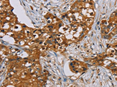 The image on the left is immunohistochemistry of paraffin-embedded Human breast cancer tissue using PSMC2 Antibody(PSMC2 Antibody) at dilution 1/25, on the right is treated with fusion protein. (Original magnification: ×200)Rabbit anti-Human PSMC2 Polyclonal Antibody
