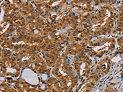 The image on the left is immunohistochemistry of paraffin-embedded Human thyroid cancer tissue using the antibody Antibody) at dilution 1/25, on the right is treated with fusion protein. (Original magnification: ×200)Rabbit anti-Human PSMC2 Polyclonal Antibody