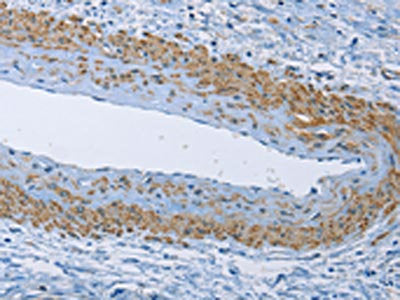 The image on the left is immunohistochemistry of paraffin-embedded Human cervical cancer tissue using ZMYND11 Antibody(ZMYND11 Antibody) at dilution 1/50, on the right is treated with fusion protein. (Original magnification: ×200)Rabbit anti-Human ZMYND11 Polyclonal Antibody
