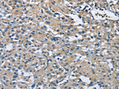 The image on the left is immunohistochemistry of paraffin-embedded Human thyroid cancer tissue using the antibody Antibody) at dilution 1/50, on the right is treated with fusion protein. (Original magnification: ×200)Rabbit anti-Human ZMYND11 Polyclonal Antibody