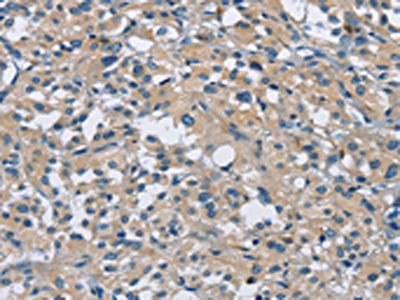 The image on the left is immunohistochemistry of paraffin-embedded Human thyroid cancer tissue using CAB39L Antibody(CAB39L Antibody) at dilution 1/30, on the right is treated with fusion protein. (Original magnification: ×200)