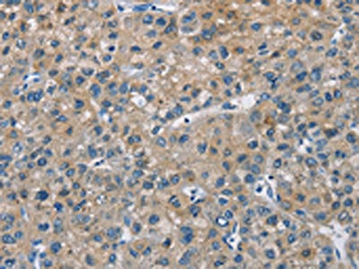 The image on the left is immunohistochemistry of paraffin-embedded Human liver cancer tissue using the antibody Antibody) at dilution 1/30, on the right is treated with fusion protein. (Original magnification: ×200)