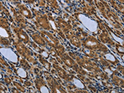 The image is immunohistochemistry of paraffin-embedded Human thyroid cancer tissue using SMAD4 Antibody(SMAD4 Antibody) at dilution 1/40. (Original magnification: ×200)Rabbit anti-Human SMAD4 Polyclonal Antibody