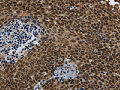 The image is immunohistochemistry of paraffin-embedded Human cervical cancer tissue using the antibody Antibody) at dilution 1/40. (Original magnification: ×200)Rabbit anti-Human SMAD4 Polyclonal Antibody