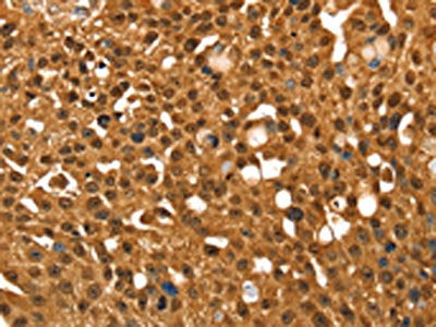 The image on the left is immunohistochemistry of paraffin-embedded Human breast cancer tissue using SRGAP1 Antibody(SRGAP1 Antibody) at dilution 1/25, on the right is treated with synthetic peptide. (Original magnification: ×200)