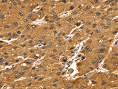 The image on the left is immunohistochemistry of paraffin-embedded Human liver cancer tissue using the antibody Antibody) at dilution 1/25, on the right is treated with synthetic peptide. (Original magnification: ×200)